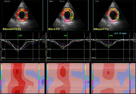 Circumferential strain F/U1 Conservative BASELINE F/U2 Intervention IMPROVEMENT