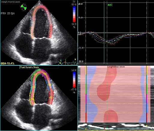 REST INOTROPIC RESERVE -IMPROVED NYHA, 6 MIN,BNP AFTER LEVOSIMENDAN DOB