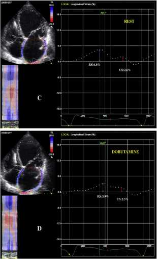 Dobutamine-induced changes of left atrial two-dimensional deformation predict clinical and neurohumoral improvement after