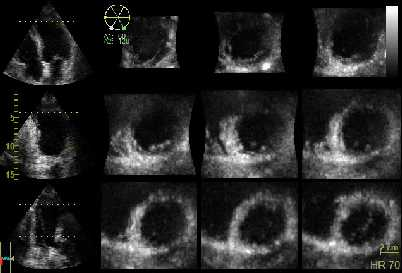 3D STRESS ECHO -Better visualization of the LV apex -Rapid acquisition of peak stress images -Evaluation of multiple