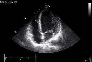 DIABETIC CARDIOMYOPATHY 5m