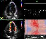 Myocardial Deformation in Acute Myocarditis With Normal LV Wall Motion:Validation with MRI DE In patients with acute myocarditis, evidence of subepicardial damage and no wall motion
