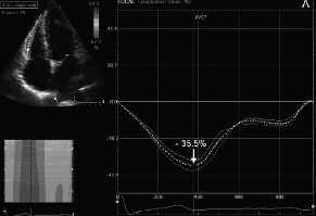 Prognostic Value of RV Longitudinal Peak Systolic Strain in Patients With PH 142 PH patients (37% PAH) 2,6y f-up Death 37 In patients with PH, RV LPSS is significantly