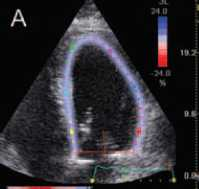 GLS predicts LV dysfunction after mitral valve repair cut-off value LV GLS 19.9% predicts long-term postoperative LV dysfunction sensitivity 90% specificity 79% A GLS of -19.