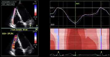 SPECKLE TRACKING -RVGLS - Τεχνική ανεξάρτητη της γωνίας - Συνολική και τμηματική