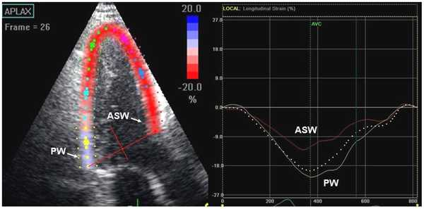 Example of impaired segmental strain measured by speckle tracking in the apical long-axis view in a mutation carrier without HCM phenotype expression. Yiu KH, Atsma DE, Delgado V, Ng ACT, et al.