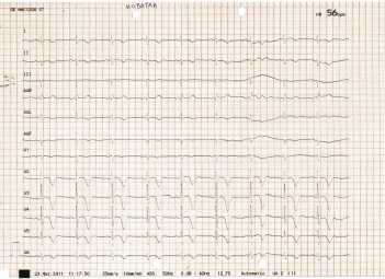 66 y old female with RA