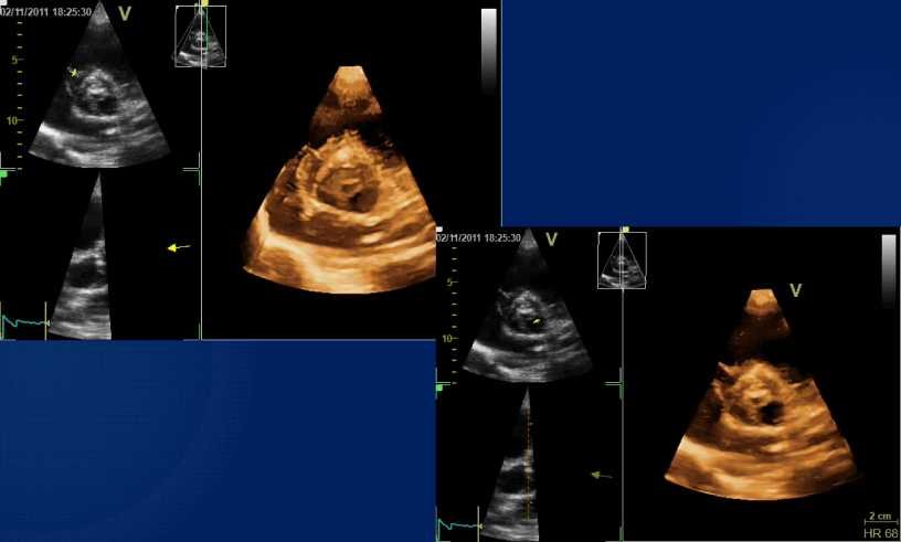 Dysplactic Ao valve-lad AV LAD Echo Lab 2nd