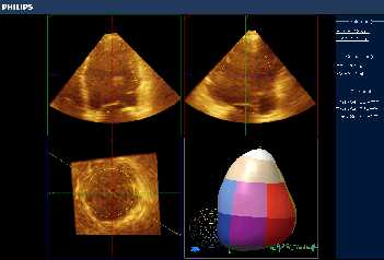 4D LV VOLUME QUANTIFICATION (4DLVQ) 3D