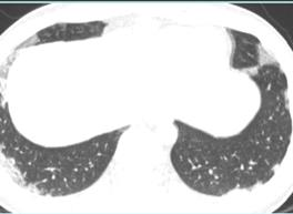HRCT Σκιάσεις θολής υάλου (100%) ή πύκνωση (92%) κυρίως περιφερικά, μέσων και άνω πνευμονικών πεδίων Ένα ή περισσότερα οζίδια
