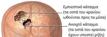 Μη διαπεραστικά τραύματα (κλειστές κρανιοεγκεφαλικές κακώσεις) Στα μη διαπεραστικά τραύματα του εγκεφάλου τα οστά του κρανίου παραμένουν άθικτα και τα ξένα υλικά δεν εισάγονται στον εγκέφαλο.