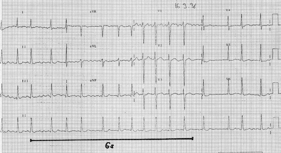 Obr. 12: EKG záznam s nepravidelnou elektrickou aktivitou srdca. Záznam EKG v II.