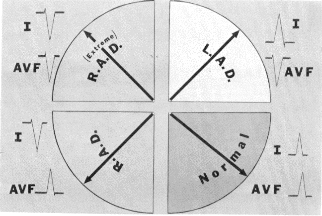 QRS komplexu negatívna, potom je jasné, že EOS bude smerovať niekde do priestoru hornej hemisféry. Je zrejmé, že ani pomocou tohto zvodu samotného nedokážeme spresniť smerovanie EOS.