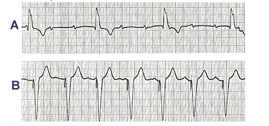 Obr. 29: Na hornom paneli A vidíme komorový rytmus vychádzajúci z ľavej komory, s nízkou frekcenciou elektrickej činnosti srdca, širokým komorovým komplexom a diskordantným postavením vlny T.