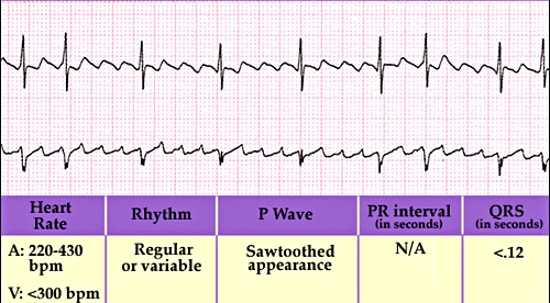 Obr. 33 Flutter predsiení (Yanowitz FG, 2007) Flutter predsiení je na EKG pomerne ľahko identifikovatelný najmä na základe typického pílovitého vzhľadu predsieňových depolarizácií a tiež prítomnosťou