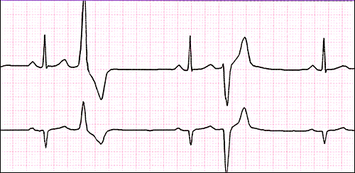 problémov rozoznať na EKG zázname (či už na papieri alebo na monitore) KEX, pretože jej prítomnosť môže byť predzvesťou vzniku závažných komorových dysrytmií, ktoré môžu ohroziť život človeka. Obr.