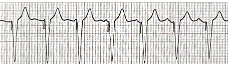 komorových komplexov, vzájomná vzdialenosť ktorých je tiež rovnaká, pričom všetky znaky elektrokardiogramu nasvedčujú, že komorová a predsieňová aktivita od seba nezávisia.