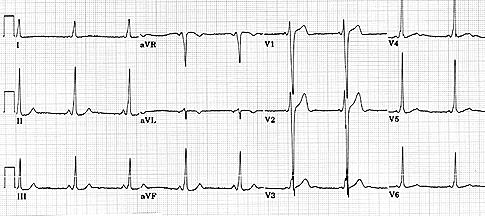 Na EKG zázname sa prejaví táto porucha ako skrátenie PQ intervalu, ktoré je spôsobené zrýchleným prevodom vzruchu cez akcesórnu dráhu na svalovinu komôr.