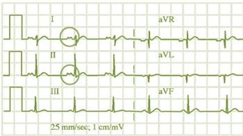 Pri depolarizácii predsiení ako celku sa na EKG registruje vlna P.