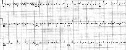 7. EKG obraz neúplnej blokády pravého Tawarovho ramienka Obr.