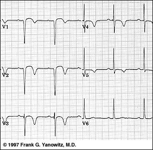 Z EKG krivky možno tiež zistiť lokalizáciu aj rozsah IM. Dôležité je zistť, či ide o IM prednej alebo zadnej/diafragmatickej časti komôr.