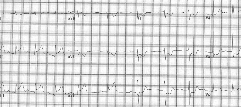 Ak sa nachádza centrum IM laterálnejšie v prednej stene ľavej komory, potom vidíme aj posun typických infarktových zmien do zvodov z ľavého prekordia a vo V 1 nenájdeme prakticky žiadne zmeny (Obr.