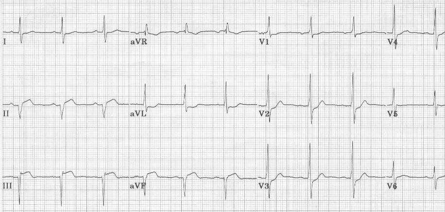 Ak je zadný infarkt vyvinutý, potom možno vidieť už len patologický Q kmit a eleváciu S-T segmentu (Obr. 68 - Yanowitz FG 2007) pozri II. a III.