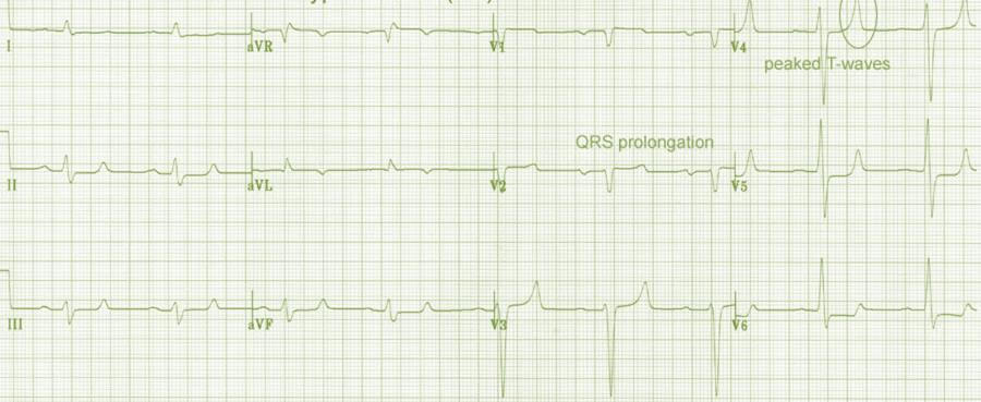 8.0 ZMENY EKG KRIVKY SPÔSOBENÉ PORUCHAMI HOMEOSTÁZY ELEKTROLYTOV J.