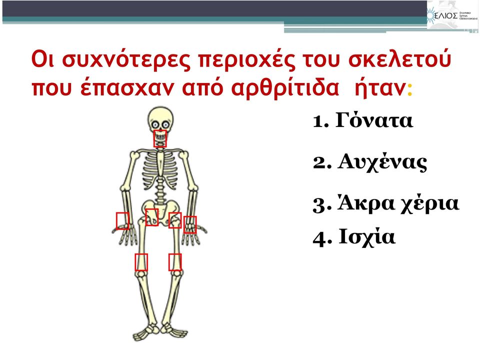 αρθρίτιδα ήταν: 1. Γόνατα 2.