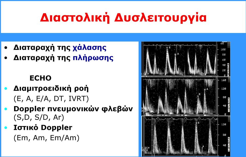 (E, A, E/A, DT, IVRT) Doppler πλεπκνληθώλ