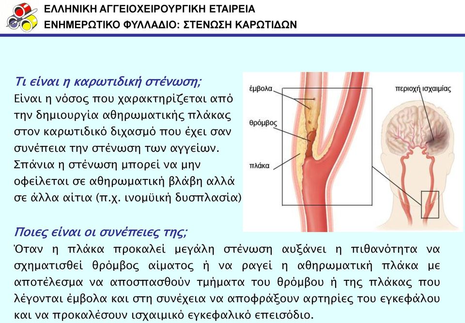 Ποιερ είναι οι ςτνέπειερ σηρ; Όσαν η πλάκα πποκαλεί μεγάλη ςσένωςη ατξάνει η πιθανόσησα να ςφημασιςθεί θπόμβορ αίμασορ ή να παγεί η αθηπωμασική πλάκα με