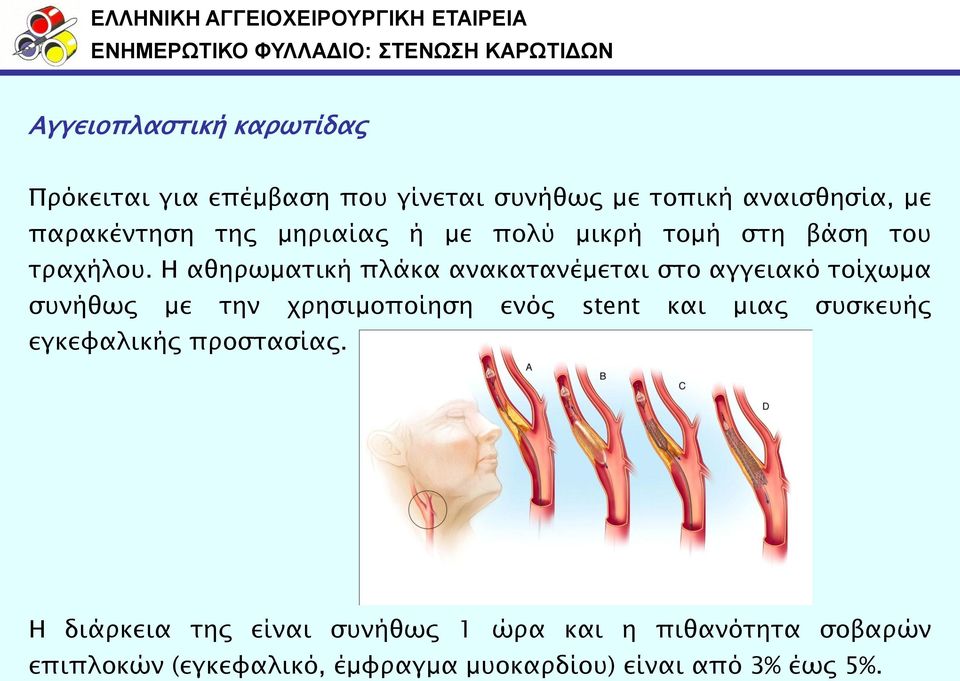 Η αθηπωμασική πλάκα ανακασανέμεσαι ςσο αγγειακό σοίφωμα ςτνήθωρ με σην φπηςιμοποίηςη ενόρ stent και μιαρ