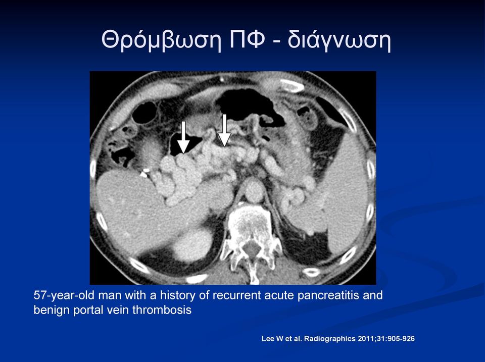 pancreatitis and benign portal vein
