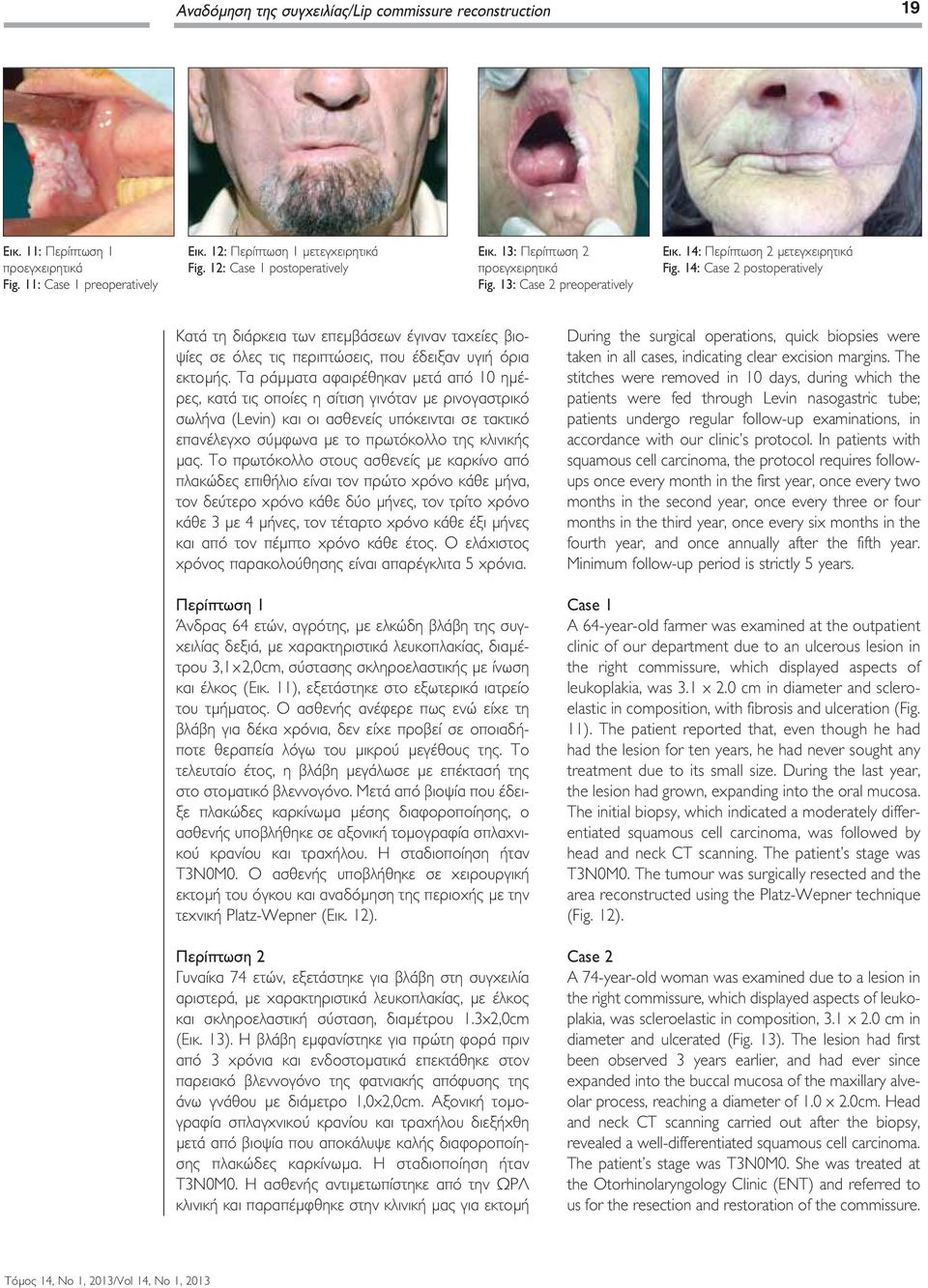 14: Case 2 postoperatively Κατά τη διάρκεια των επεµβάσεων έγιναν ταχείες βιοψίες σε όλες τις περιπτώσεις, που έδειξαν υγιή όρια εκτοµής.