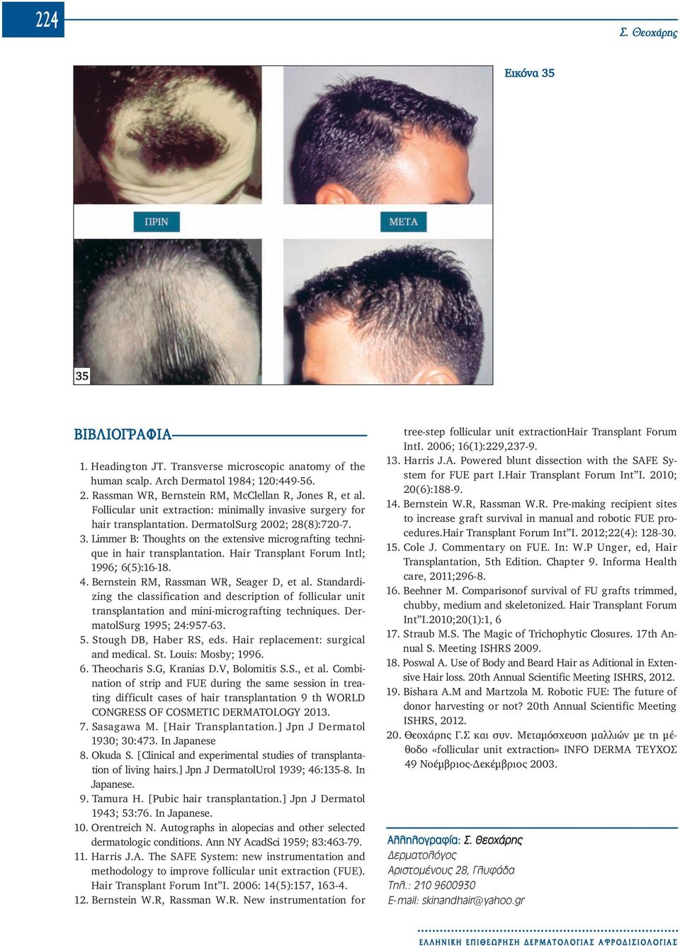 Limmer B: Thoughts on the extensive micrografting technique in hair transplantation. Hair Transplant Forum Intl; 1996; 6(5):16-18. 4. Bernstein RM, Rassman WR, Seager D, et al.