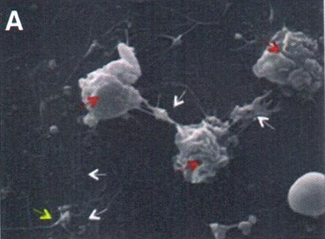 Leukocytes coincubated with human sperm trigger classic neutrophil extracellular traps