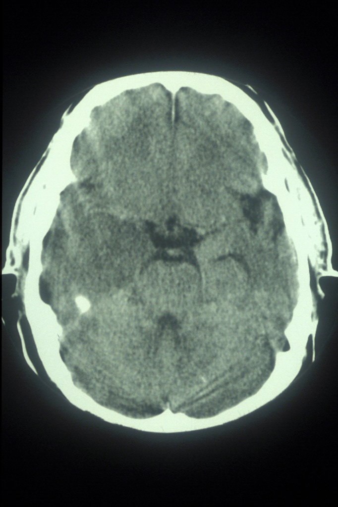 CT showing lucency of the mesial