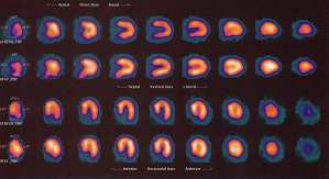 SPECT Q-analysis 77 µε ιστορικο παλαιου κατωτερου Ε και αραια επεισοδια προκαρδίου αλγους