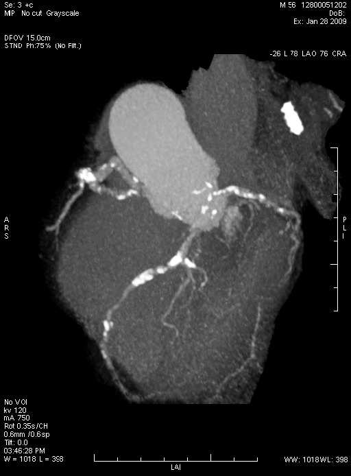 Asymptomatic preclinical type of CAD Example of a 56-year-old asymptomatic man w/ an intermediate SCORE of 5%.