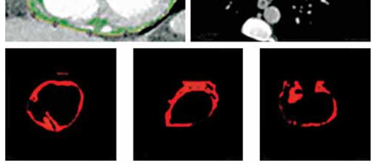 Coronary CTA CT Scanner GE 64-slice CT (Light speed VCT, XT Low dose acquisition (1mSv) for the sequential measurements of Coronary Artery Calcium Score-CACS- and epicardial adipose tissue- ΕΑΤ-