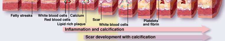 Development of Atherosclerotic Coronary Artery Calcium A Subcomponent Plaque of Atheroma- Theoretical Relationsship to CHD Eve Bostrom K, et al. J Clin Invest. 1993;91:1800 1809. Hirota S, et al.