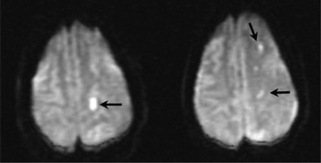 Diffusion-weighted MRI (DWI) Τα µη αναπηρικά (ελάσσονα) περιεπεµβατικά ΑΕΕ φαίνεται ότι έχουν σηµαντική δυσµενή επίδραση στην µετέπειτα ποιότητα ζωής σε