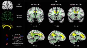 In vivo μελέτη της χωρικής κατανομής των μεταβολών της λευκής ουσίας σε ασθενείς με πλάγια μυατροφική σκλήρυνση 11 Εικόνα 7.
