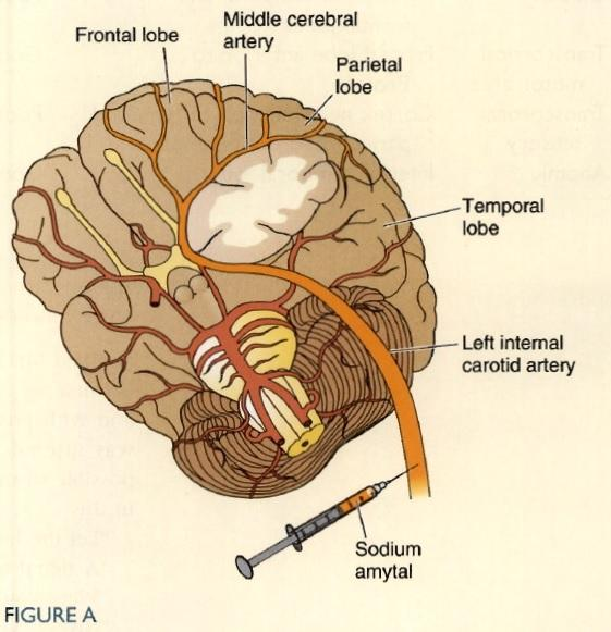 Intracarotid Sodium