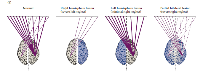 (A) Composite of the location of the underlying lesions in eight patients diagnosed with contralateral neglect syndrome. The site of damage was ascertained from CT scans.