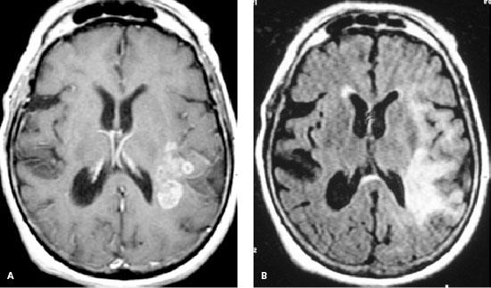Magnetic resonance imaging sequences in a patient with left frontoparietal glioblastoma multiforme.