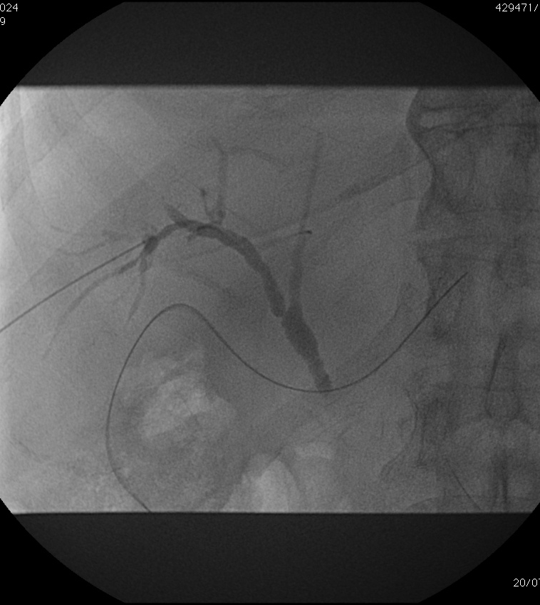 Percutaneous transhepatic cholangiography PTC diagnostic procedure : sterile placement of a 21-g or smaller needle into peripheral biliary radicles with use of imaging guidance,