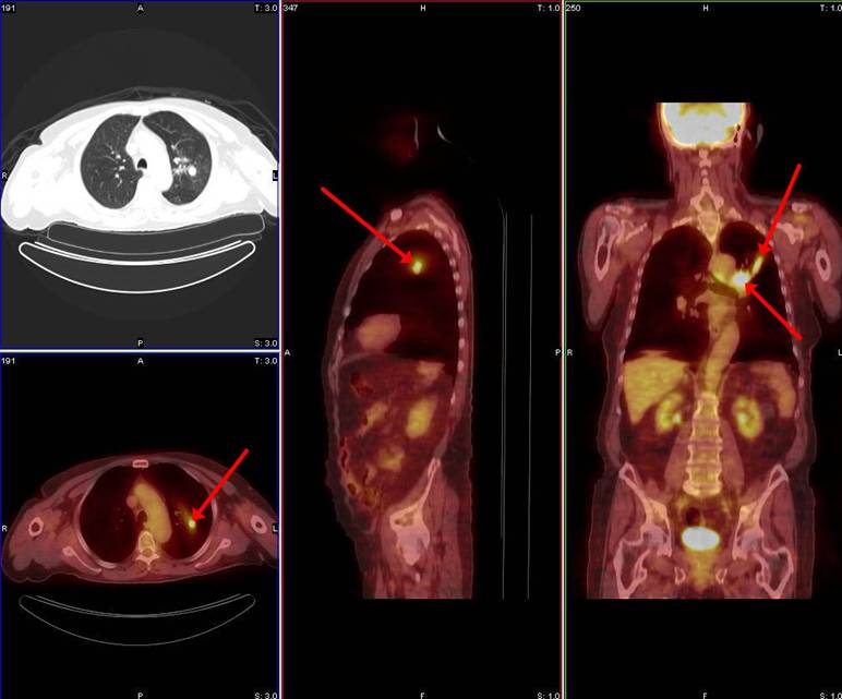 Μονήρης πνευµονικός όζος: Διαγνωστική προσέγγιση Πτολεµαίδα, 11-12/04/2014 Πελετίδου Ε.