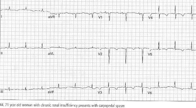 Long QT Syndrome Παράταση QT>450 msec Πρώϊμη επαναπόλωση Πολύμορφη κοιλιακή ταχυκαρδία Συγκοπτικά επεισόδια, καρδιακή ανακοπή