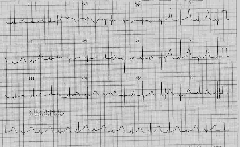 LQTS QT=520 ms, Κολπική